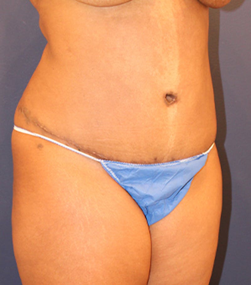 Tummy Tuck Before & After Gallery - Patient 174163233 - Image 4