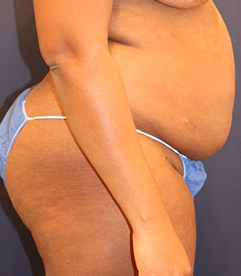 Tummy Tuck Before & After Gallery - Patient 174163233 - Image 5