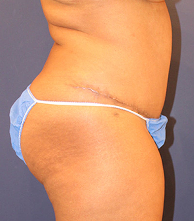 Tummy Tuck Before & After Gallery - Patient 174163233 - Image 6