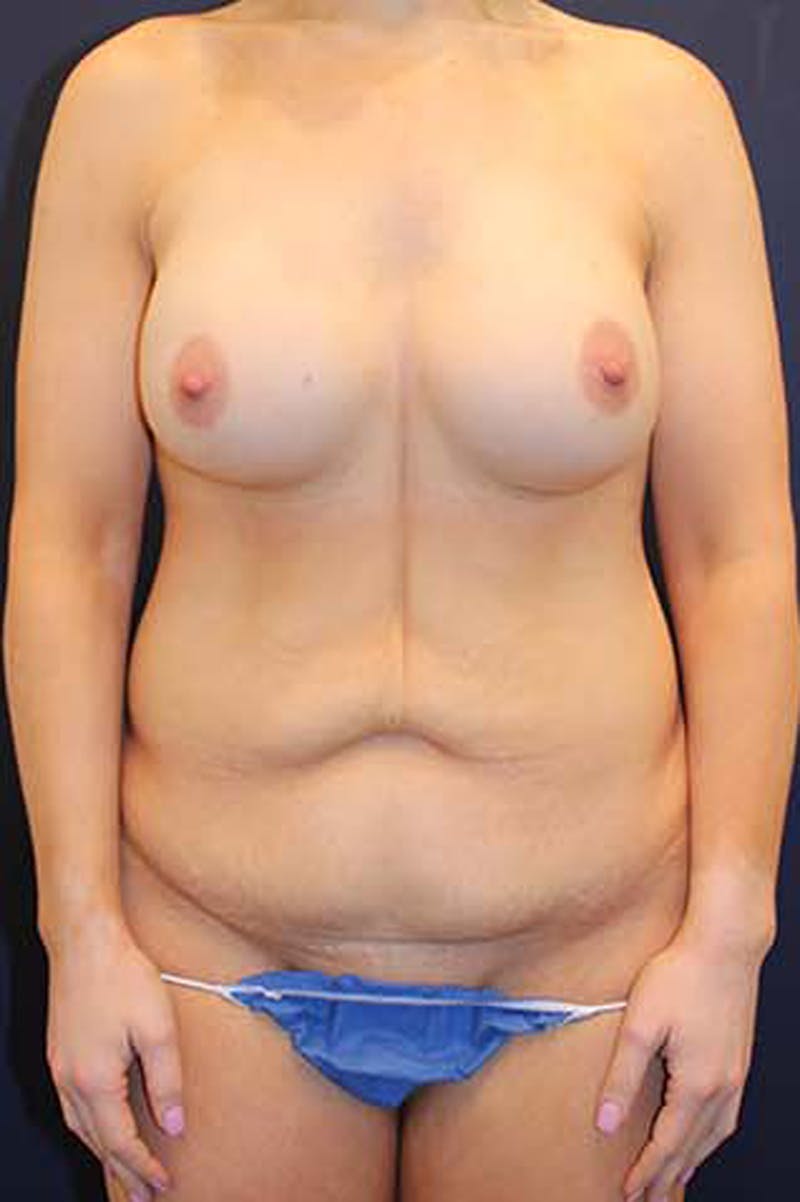 Tummy Tuck Before & After Gallery - Patient 174163240 - Image 1