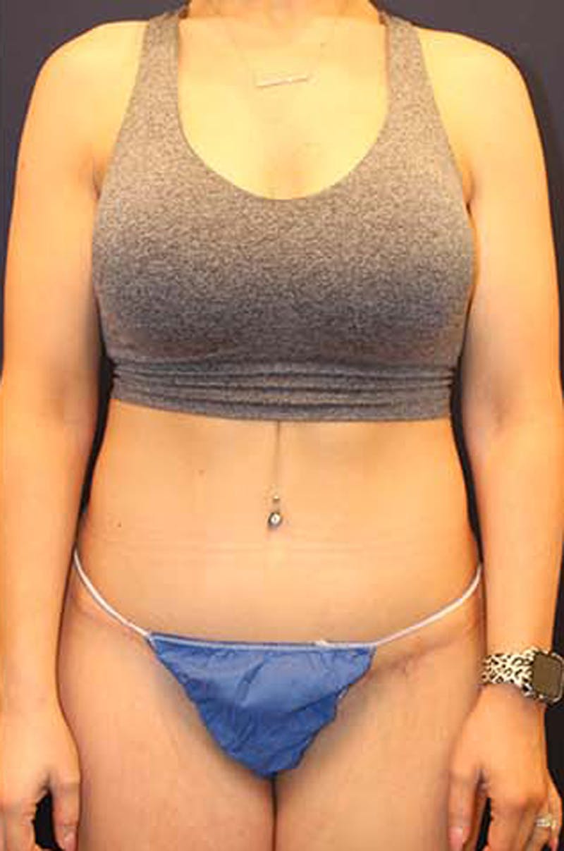 Tummy Tuck Before & After Gallery - Patient 174163240 - Image 2