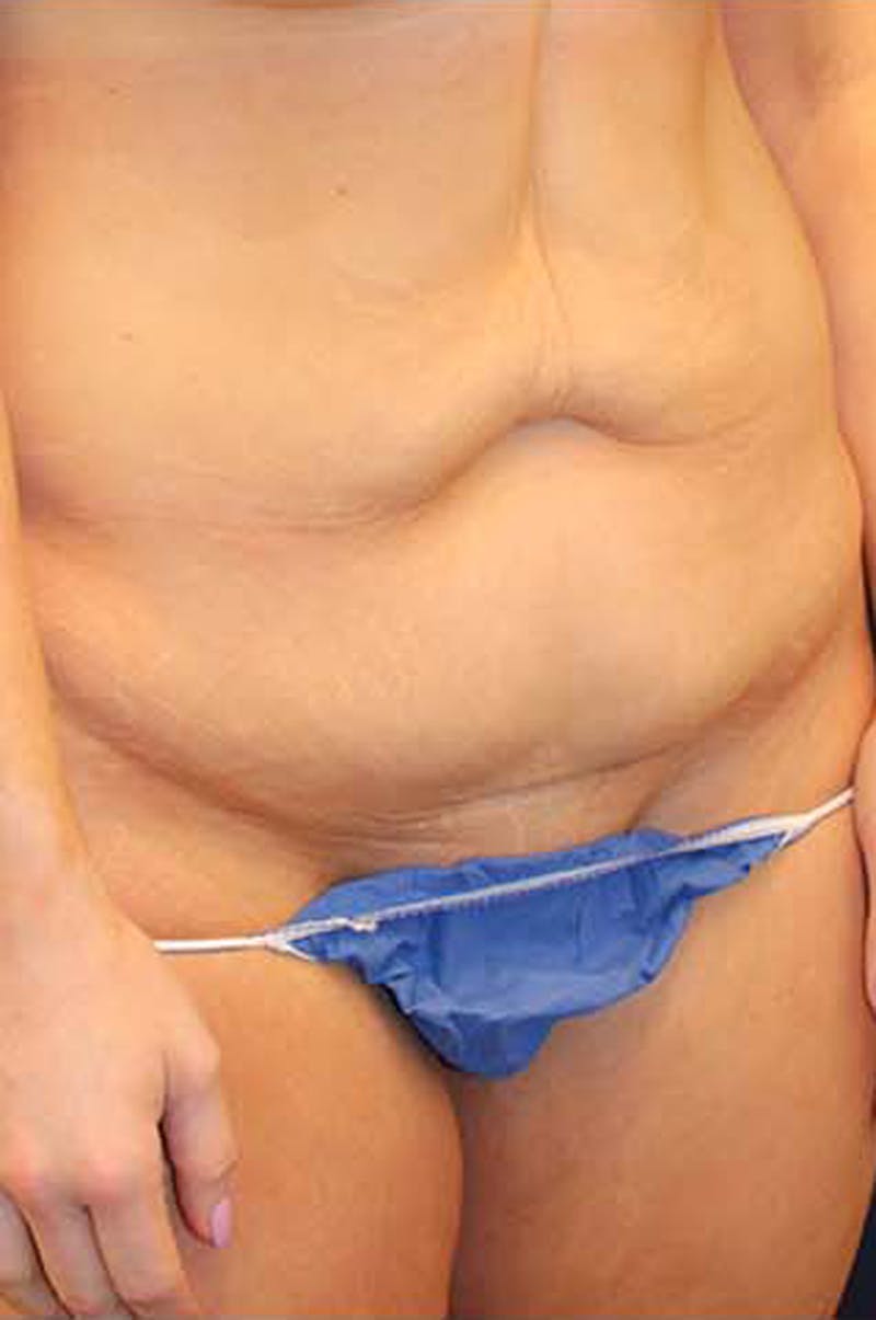 Tummy Tuck Before & After Gallery - Patient 174163240 - Image 3