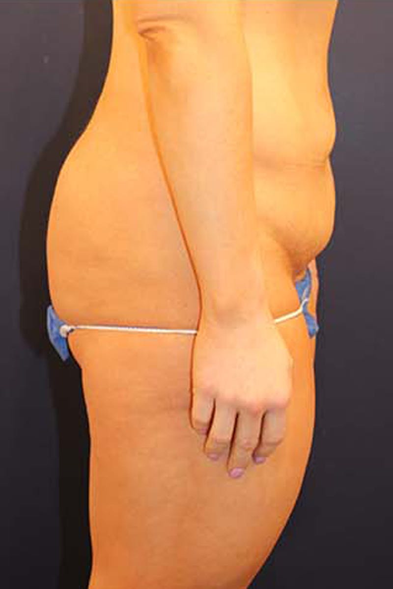 Tummy Tuck Before & After Gallery - Patient 174163240 - Image 5