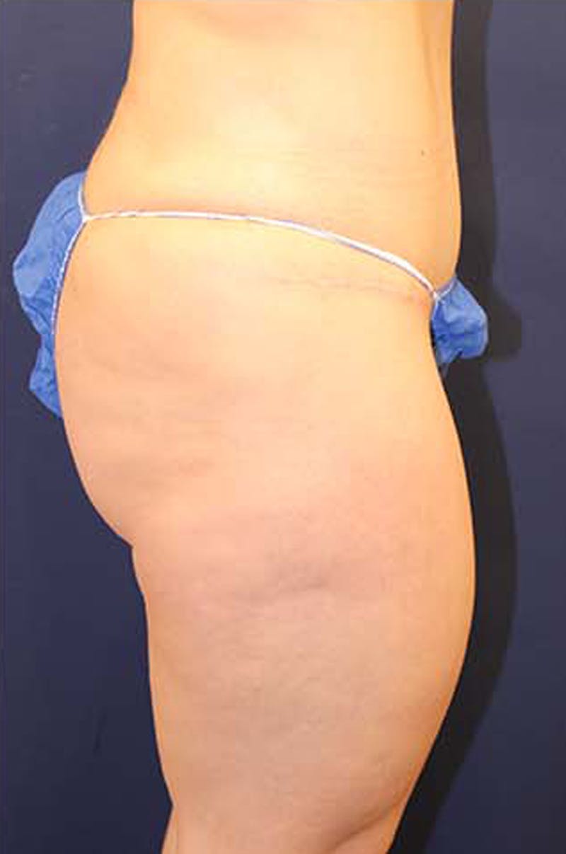 Tummy Tuck Before & After Gallery - Patient 174163240 - Image 6