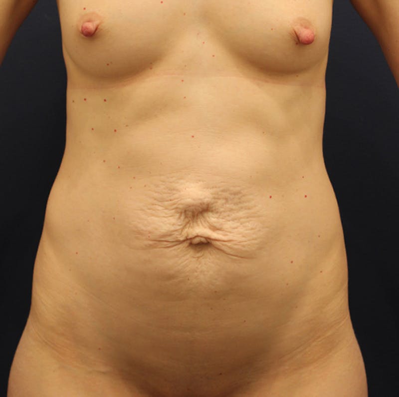 Tummy Tuck Before & After Gallery - Patient 174163252 - Image 1