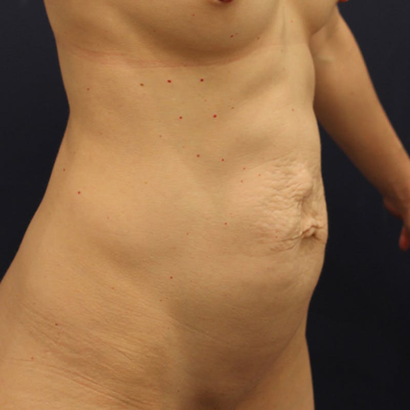 Tummy Tuck Before & After Gallery - Patient 174163252 - Image 3