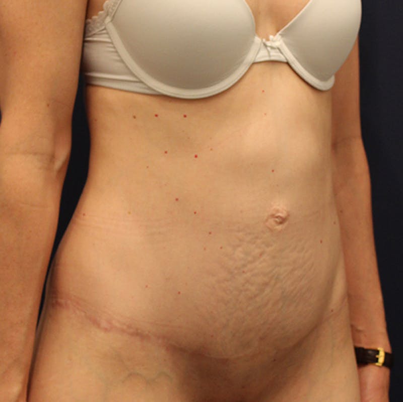 Tummy Tuck Before & After Gallery - Patient 174163252 - Image 4