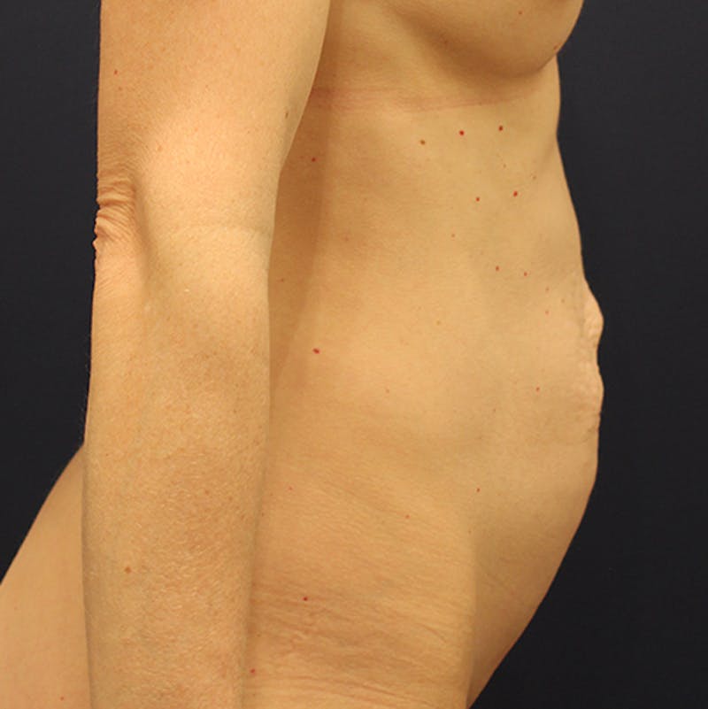 Tummy Tuck Before & After Gallery - Patient 174163252 - Image 5