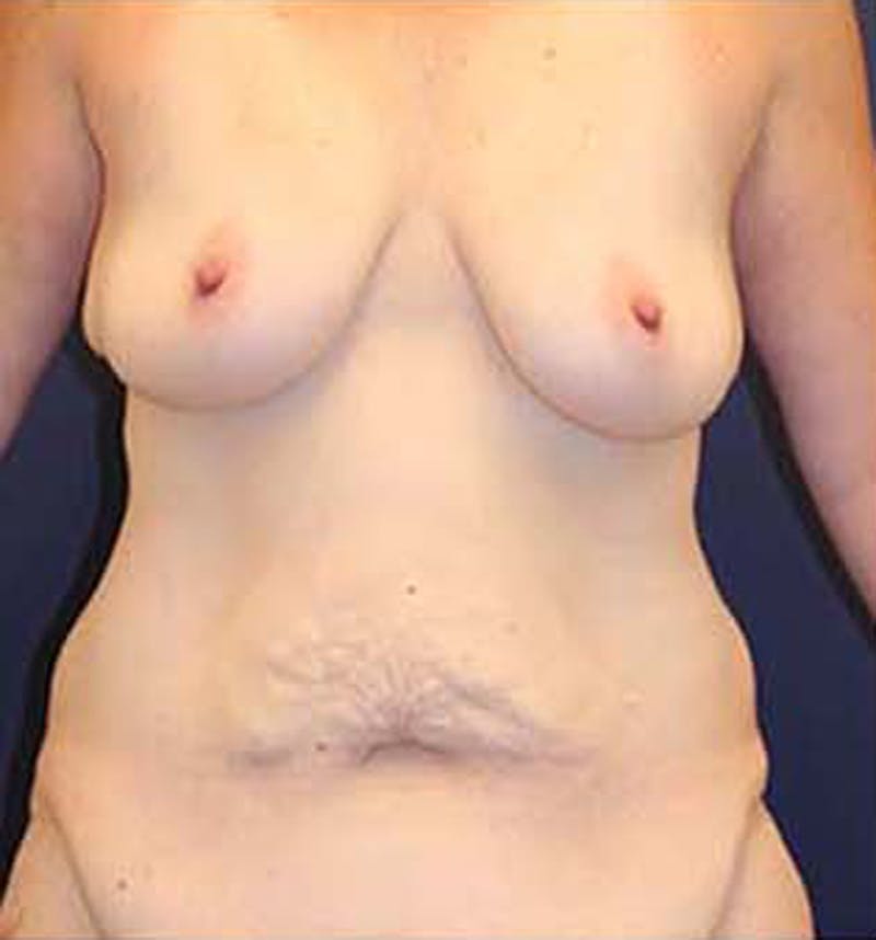 Tummy Tuck Before & After Gallery - Patient 174163257 - Image 1