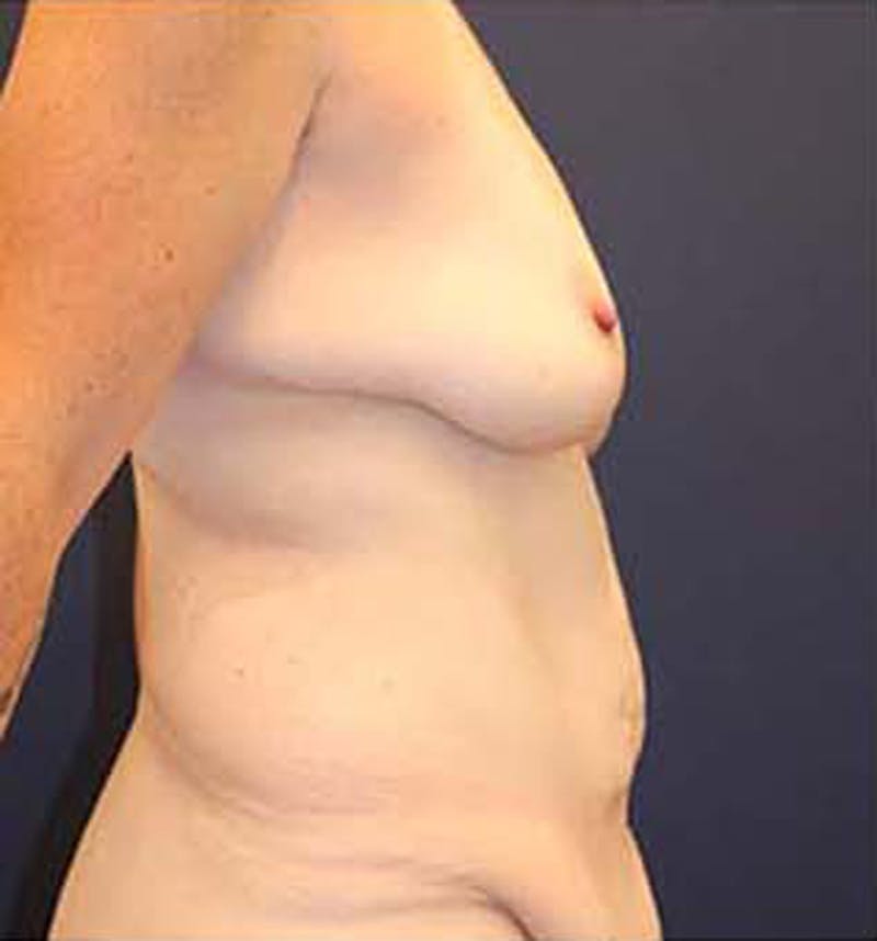 Tummy Tuck Before & After Gallery - Patient 174163257 - Image 5