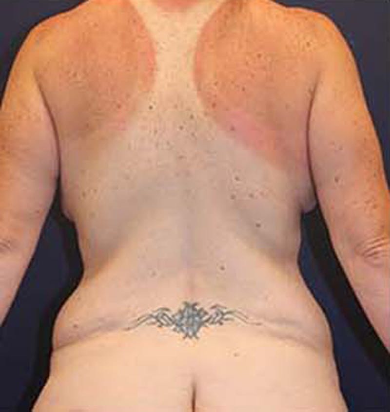 Tummy Tuck Before & After Gallery - Patient 174163257 - Image 7