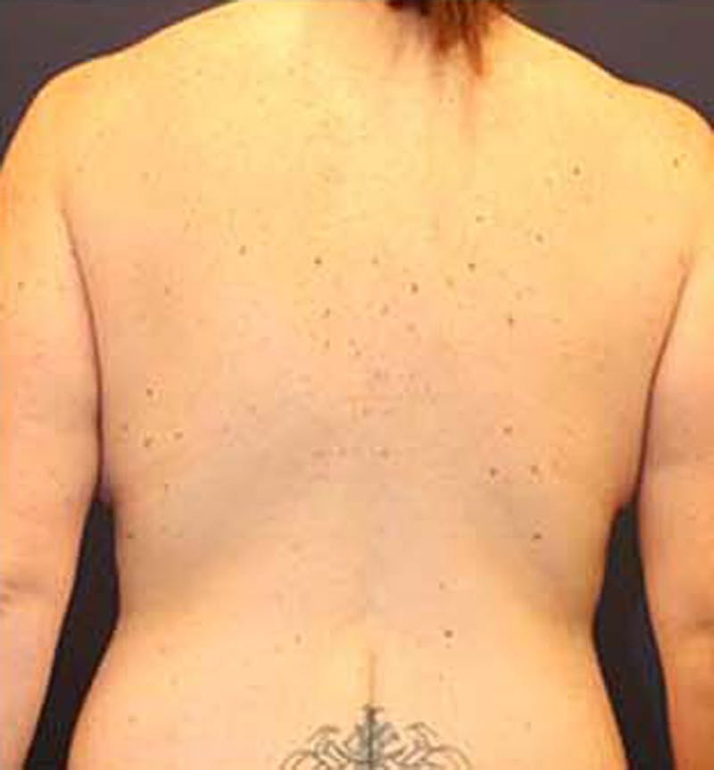 Tummy Tuck Before & After Gallery - Patient 174163257 - Image 8