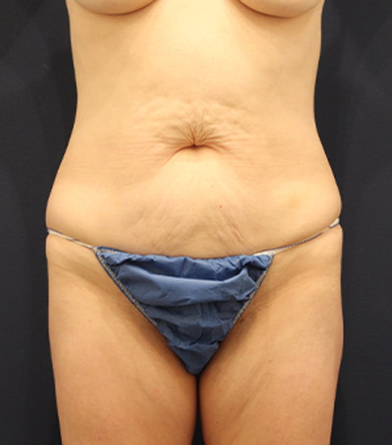 Tummy Tuck Before & After Gallery - Patient 174163266 - Image 1