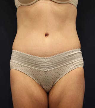 Tummy Tuck Before & After Gallery - Patient 174163266 - Image 2