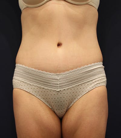 Tummy Tuck Before & After Gallery - Patient 174163266 - Image 2