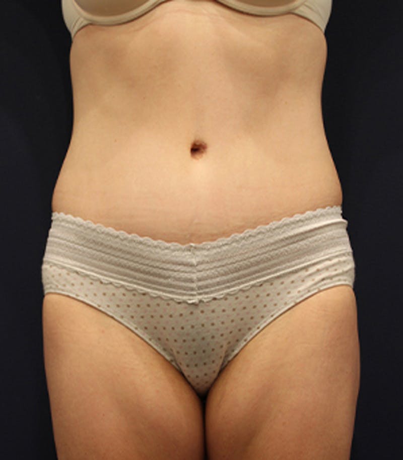 Tummy Tuck Before & After Gallery - Patient 174163266 - Image 2