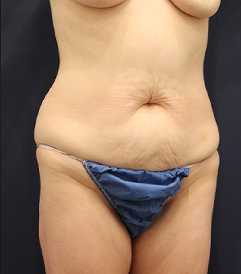Tummy Tuck Before & After Gallery - Patient 174163266 - Image 3