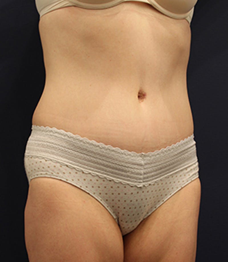 Tummy Tuck Before & After Gallery - Patient 174163266 - Image 4