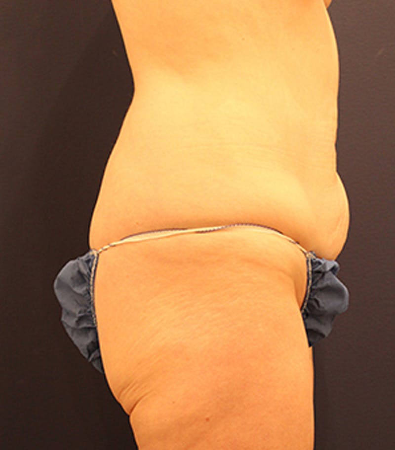 Tummy Tuck Before & After Gallery - Patient 174163266 - Image 5