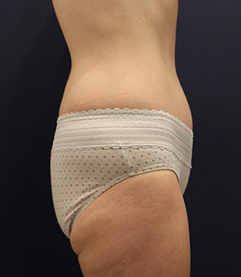 Tummy Tuck Before & After Gallery - Patient 174163266 - Image 6