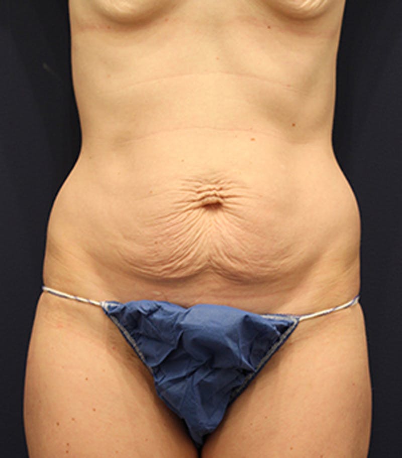 Tummy Tuck Before & After Gallery - Patient 174163274 - Image 1