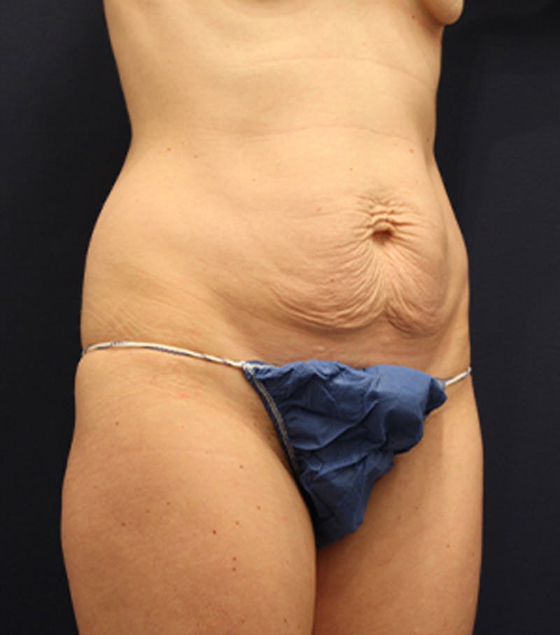Tummy Tuck Before & After Gallery - Patient 174163274 - Image 3