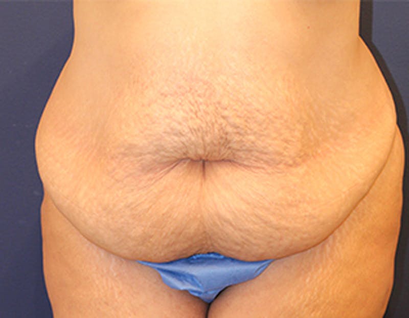 Tummy Tuck Before & After Gallery - Patient 174163286 - Image 1