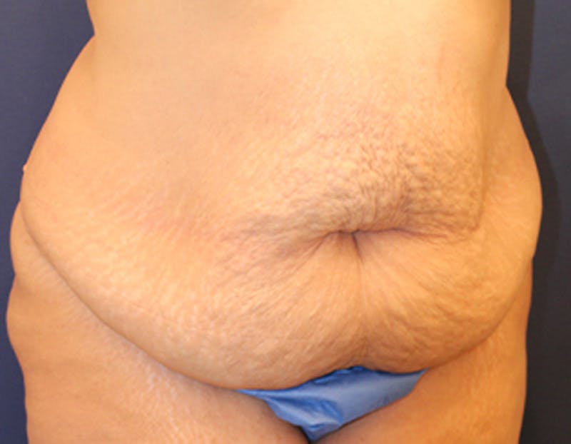 Tummy Tuck Before & After Gallery - Patient 174163286 - Image 3