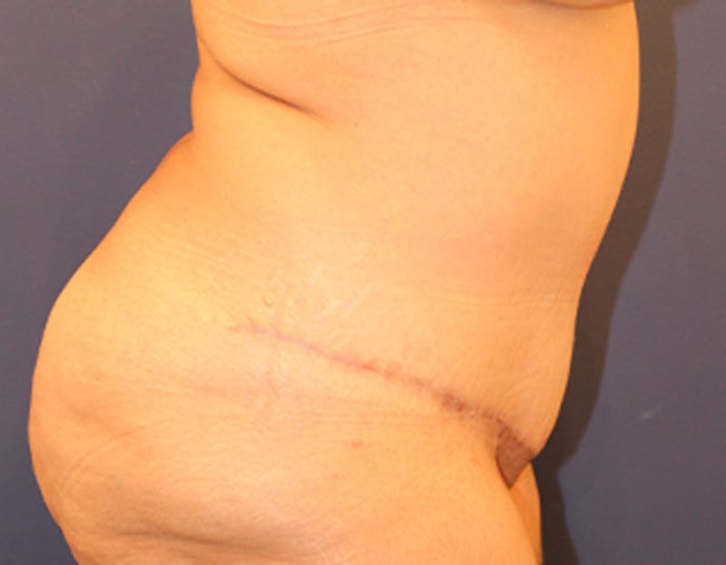 Tummy Tuck Before & After Gallery - Patient 174163286 - Image 6