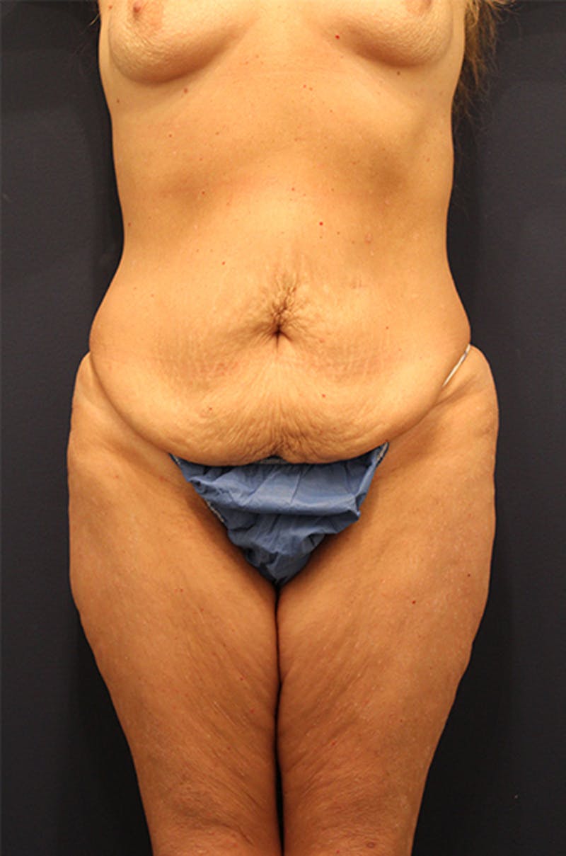 Tummy Tuck Before & After Gallery - Patient 174163297 - Image 1