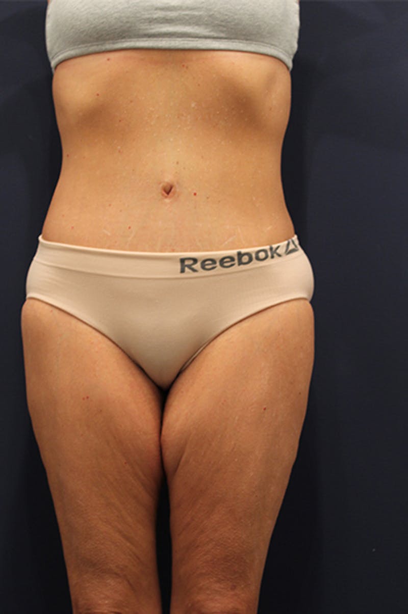 Tummy Tuck Before & After Gallery - Patient 174163297 - Image 2