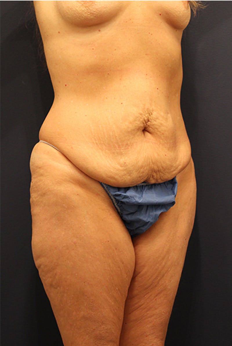 Tummy Tuck Before & After Gallery - Patient 174163297 - Image 3