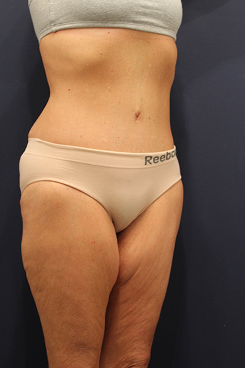Tummy Tuck Before & After Gallery - Patient 174163297 - Image 4