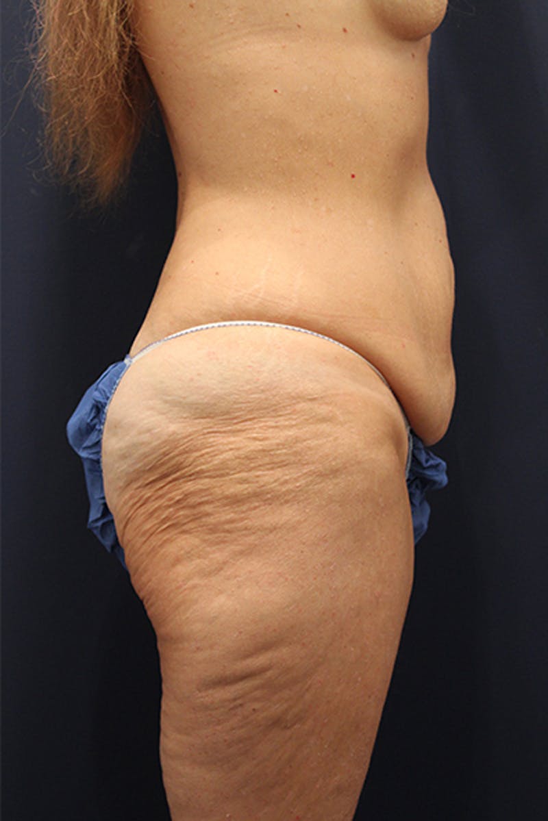 Tummy Tuck Before & After Gallery - Patient 174163297 - Image 5