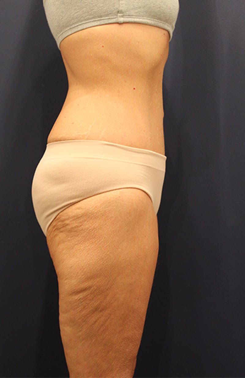 Tummy Tuck Before & After Gallery - Patient 174163297 - Image 6