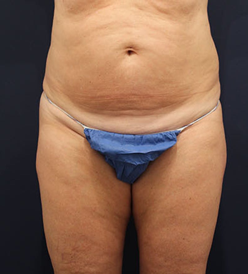 Tummy Tuck Before & After Gallery - Patient 174163302 - Image 1