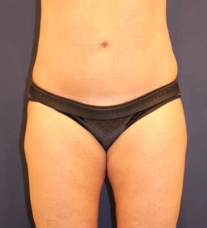 Tummy Tuck Before & After Gallery - Patient 174163302 - Image 2