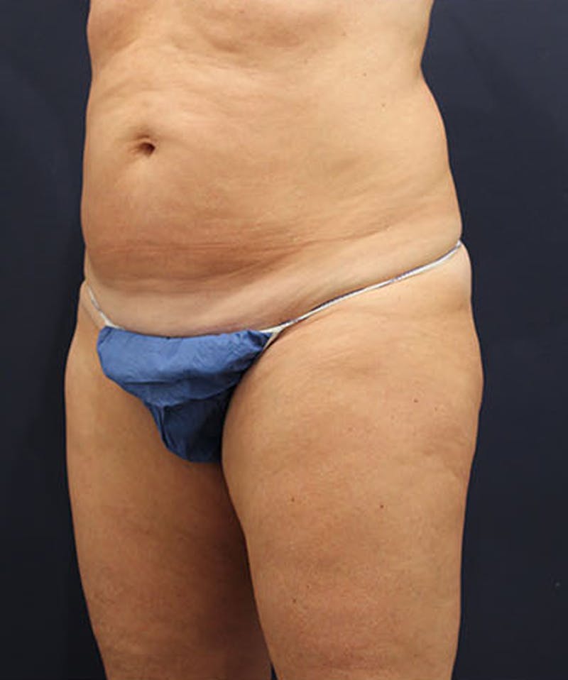 Tummy Tuck Before & After Gallery - Patient 174163302 - Image 3
