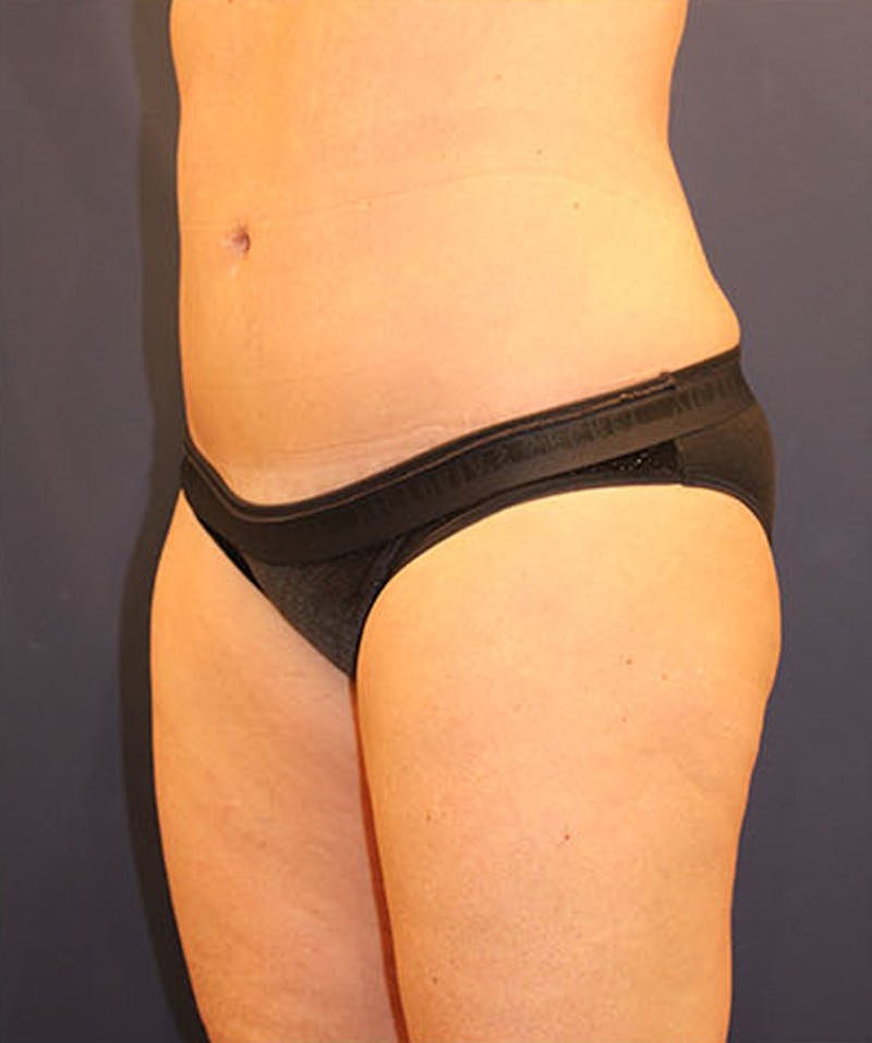 Tummy Tuck Before & After Gallery - Patient 174163302 - Image 4