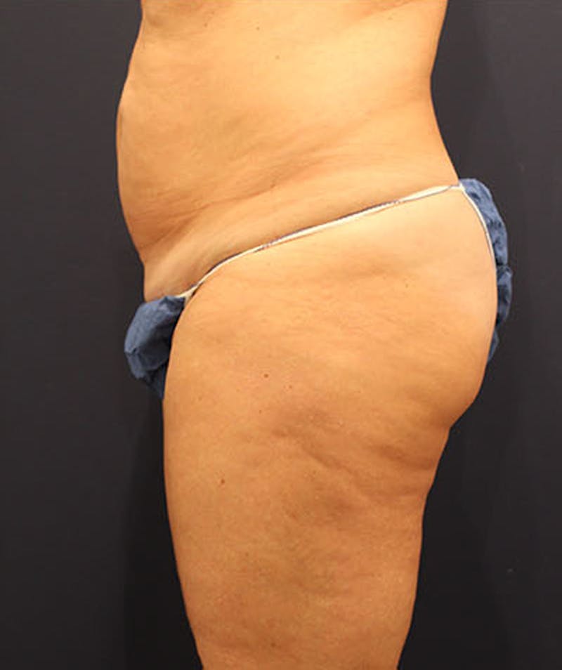 Tummy Tuck Before & After Gallery - Patient 174163302 - Image 5