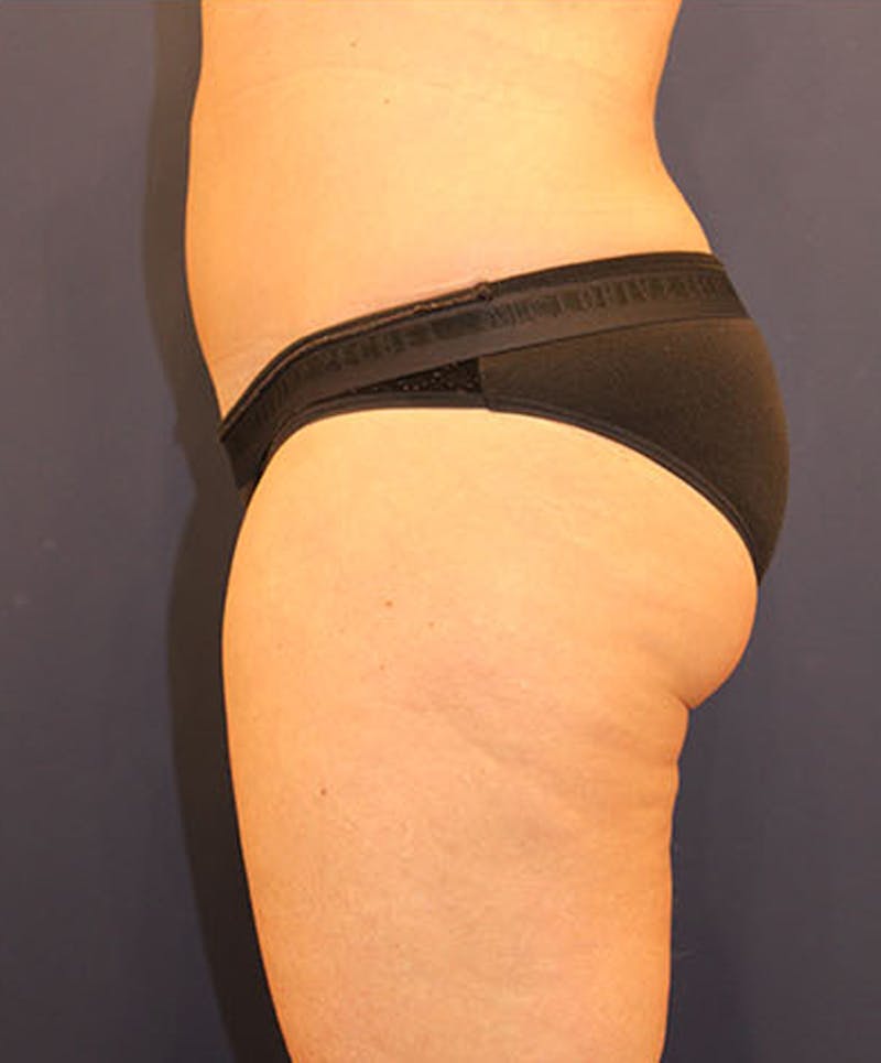 Tummy Tuck Before & After Gallery - Patient 174163302 - Image 6