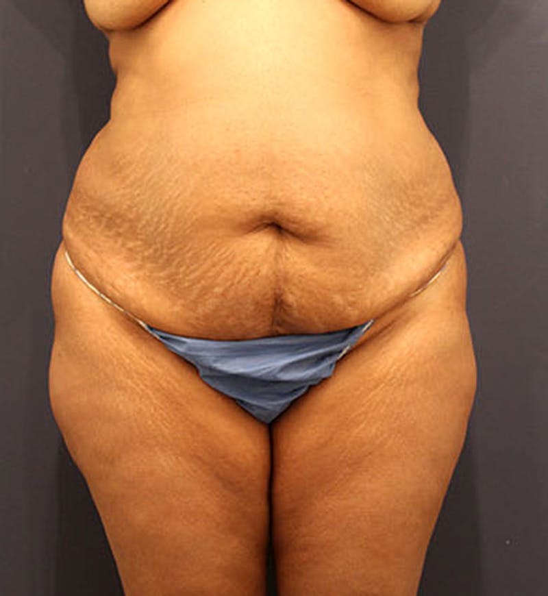 Tummy Tuck Before & After Gallery - Patient 174163310 - Image 1