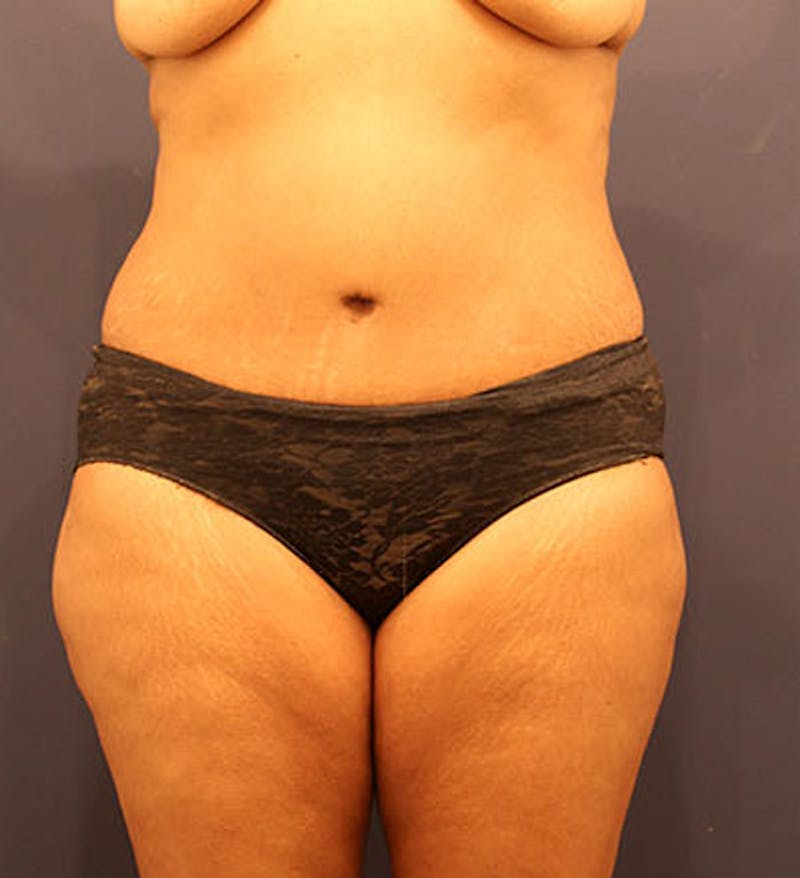 Tummy Tuck Before & After Gallery - Patient 174163310 - Image 2