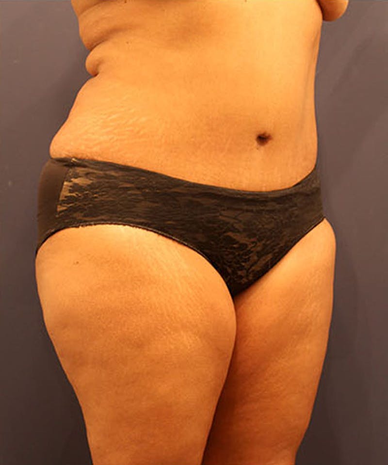 Tummy Tuck Before & After Gallery - Patient 174163310 - Image 4