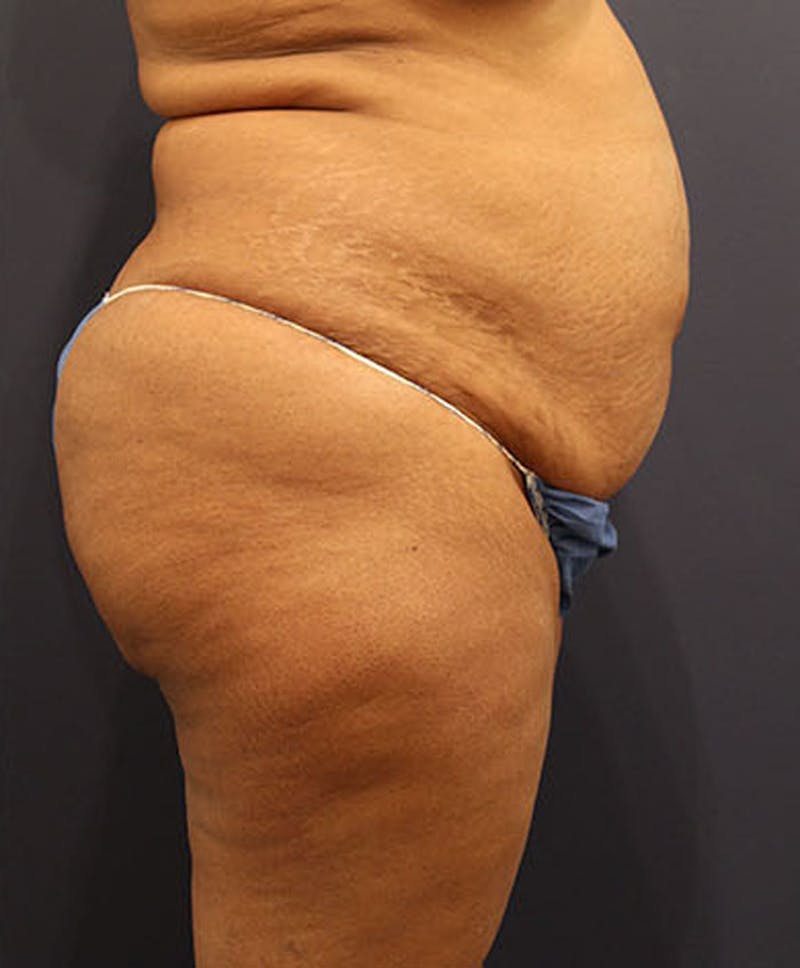 Tummy Tuck Before & After Gallery - Patient 174163310 - Image 5