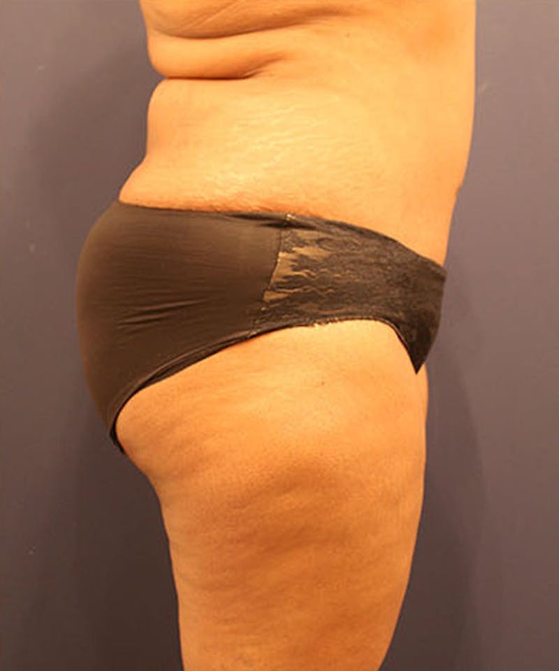 Tummy Tuck Before & After Gallery - Patient 174163310 - Image 6
