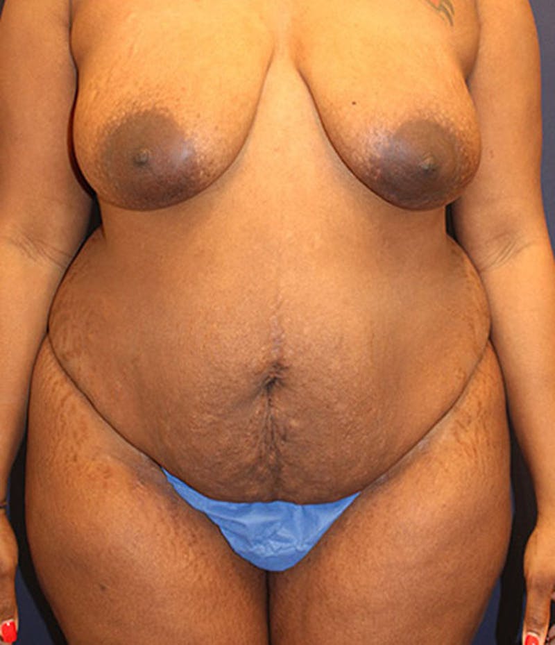 Tummy Tuck Before & After Gallery - Patient 174163317 - Image 1