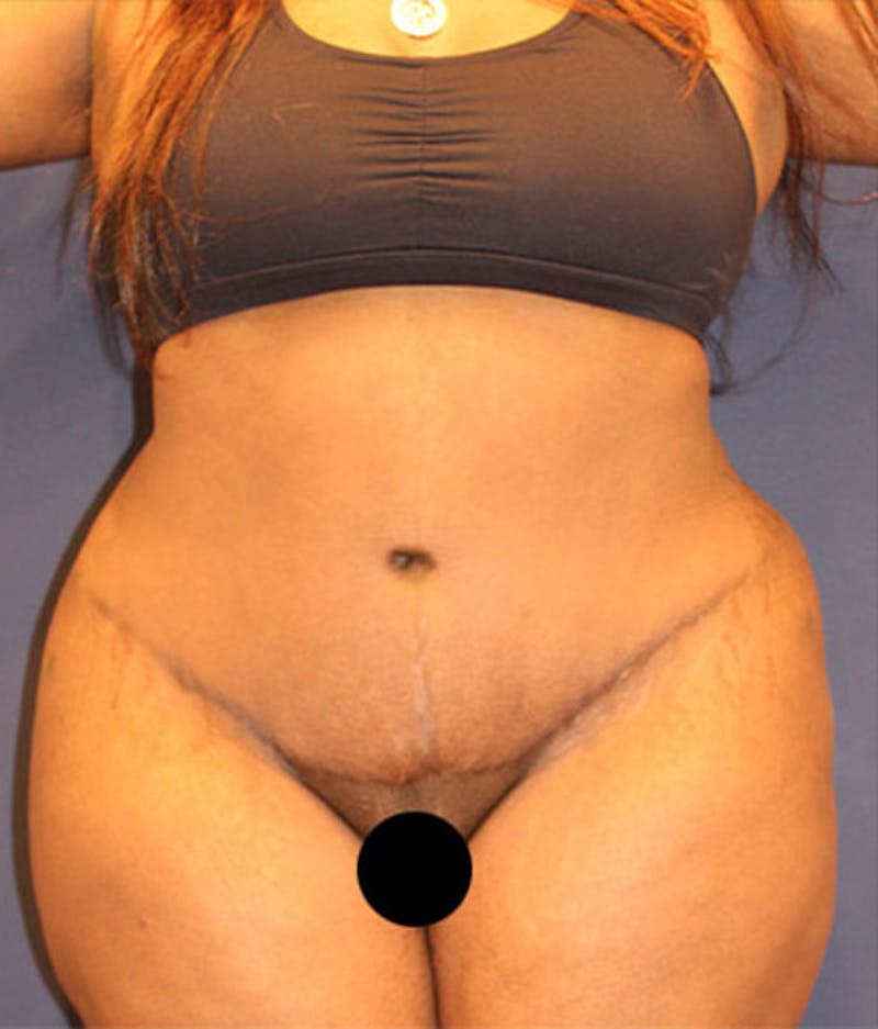 Tummy Tuck Before & After Gallery - Patient 174163317 - Image 2