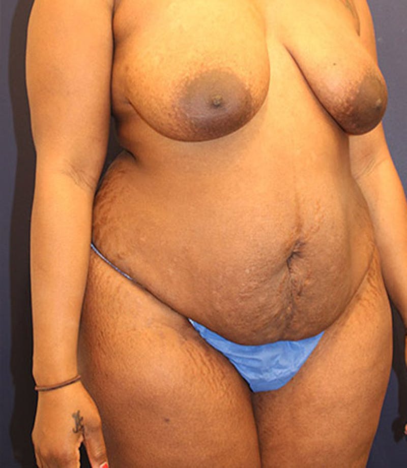 Tummy Tuck Before & After Gallery - Patient 174163317 - Image 3