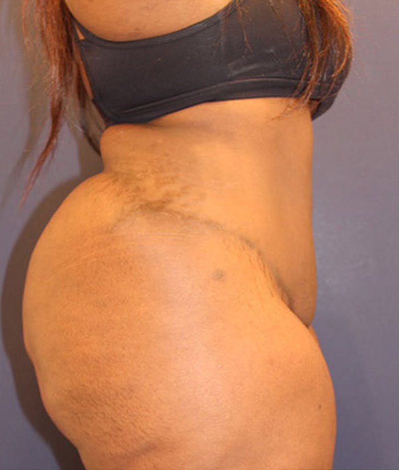 Tummy Tuck Before & After Gallery - Patient 174163317 - Image 6